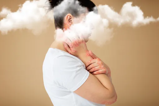 Больше половины людей с экземой страдают от расстройства психики