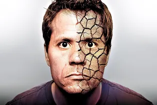 Проказа: куда девалась эта болезнь и какой шанс заразиться Проказа: куда девалась эта болезнь и какой шанс заразиться