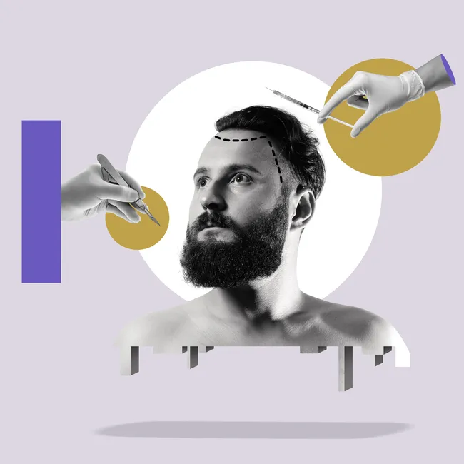 Пересадка волос: ответы на главные вопросы