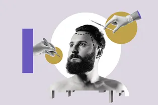 Пересадка волос: ответы на главные вопросы