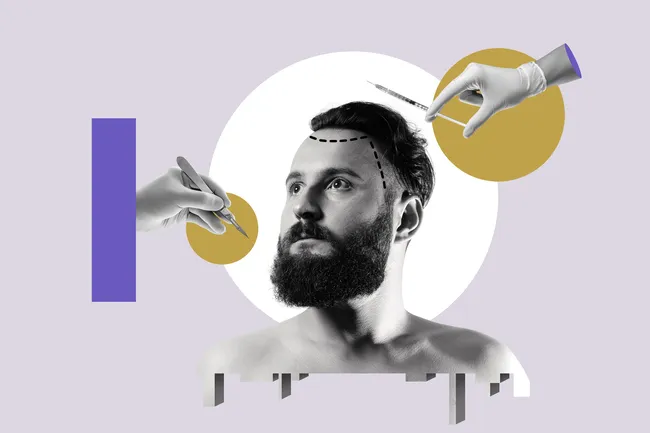 Пересадка волос: ответы на главные вопросы