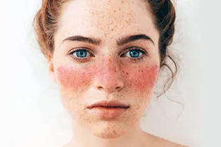 Красная волчанка: что это такое и у кого она появляется? Красная волчанка: что это такое и у кого она появляется?