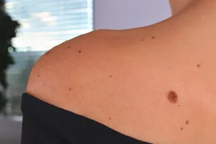 Опасно ли появление родинок на теле